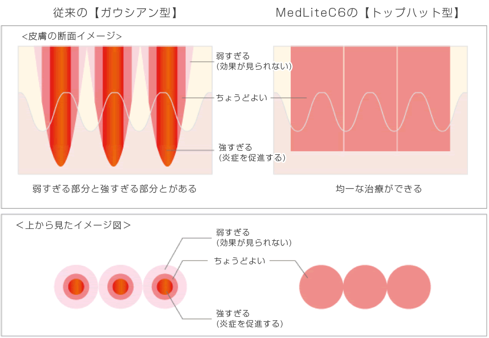 高出力レーザー