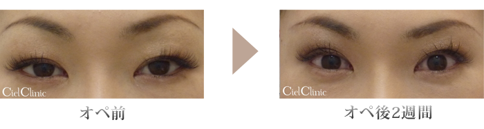 眉下切開 六本木 シエルクリニック 公式 ミッドタウン六本木近く 鼻孔縁形成 小鼻形成 眉下切開