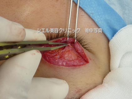 しょういんしん縮小画像 小陰唇縮小手術のモニター患者写真（超レア）