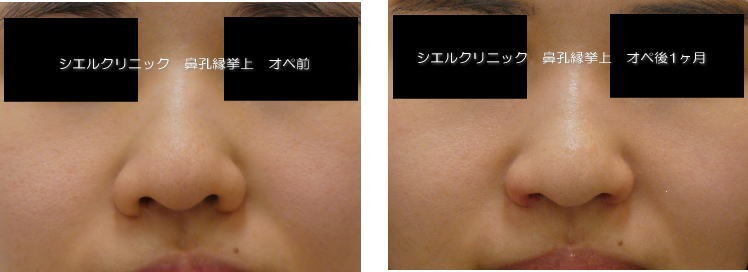 ブログ 鼻孔縁挙上 鼻孔縁挙上術の効果と失敗・修正のすべて！