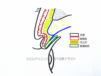 眉下切開