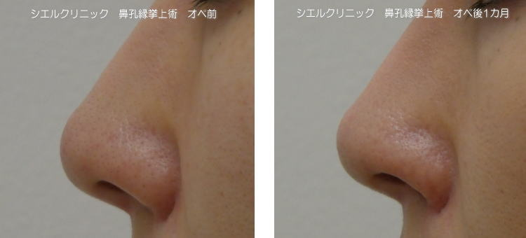 鼻孔縁挙上　小鼻縮小修正（鼻翼縮小修正）　症例写真